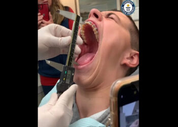 ലോകത്തെ-ഏറ്റവും-വലിയ-‘വാ-പൊളിയൻ’,-ജോൺസൺ-എന്തും-വയ്ക്കകത്താക്കാം