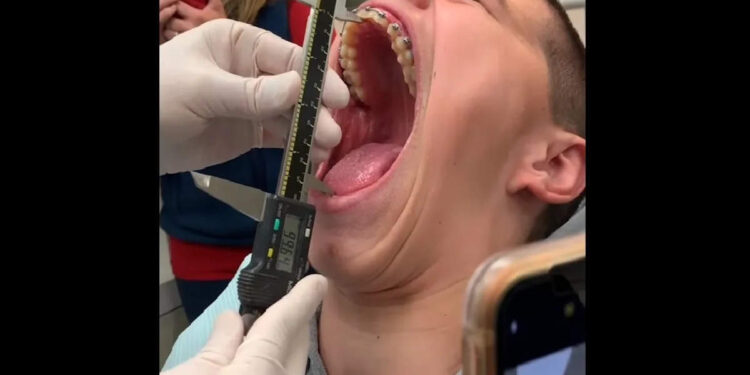 ലോകത്തെ-ഏറ്റവും-വലിയ-‘വാ-പൊളിയൻ’,-ജോൺസൺ-എന്തും-വയ്ക്കകത്താക്കാം