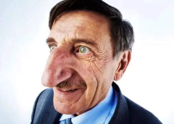 ലോകത്തിലെ-ഏറ്റവും-വലിയ-മൂക്കുള്ള-വ്യക്തി,-മെഹ്മെറ്റ്-ഓസ്യൂറെക്ക്