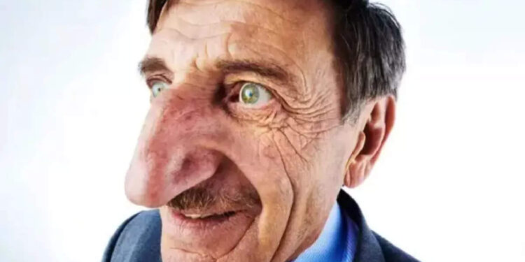 ലോകത്തിലെ-ഏറ്റവും-വലിയ-മൂക്കുള്ള-വ്യക്തി,-മെഹ്മെറ്റ്-ഓസ്യൂറെക്ക്