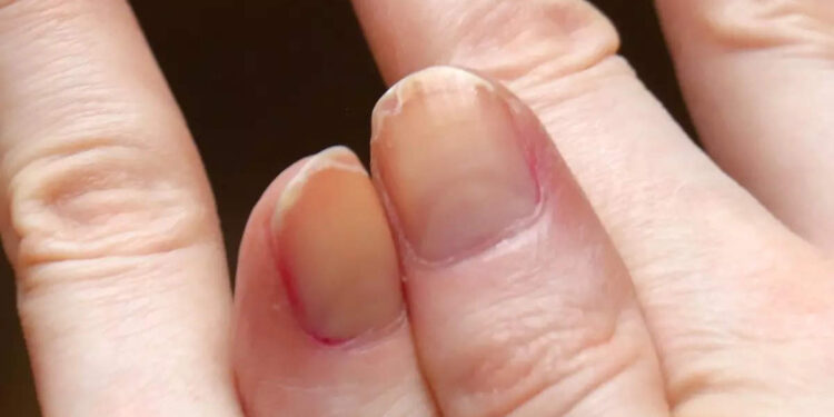 നഖം-പറയും-നിങ്ങളുടെ-ആരോഗ്യം;-ഈ-മാറ്റങ്ങൾ-ശ്രദ്ധിക്കൂ