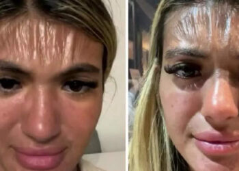 വെറും-30-മിനിറ്റ്-വെയിലത്ത്-ഉറങ്ങി;-യുവതിയുടെ-നെറ്റിത്തടം-പ്ലാസിക്-പോലെ-ഉരുകി