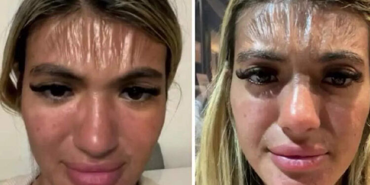 വെറും-30-മിനിറ്റ്-വെയിലത്ത്-ഉറങ്ങി;-യുവതിയുടെ-നെറ്റിത്തടം-പ്ലാസിക്-പോലെ-ഉരുകി