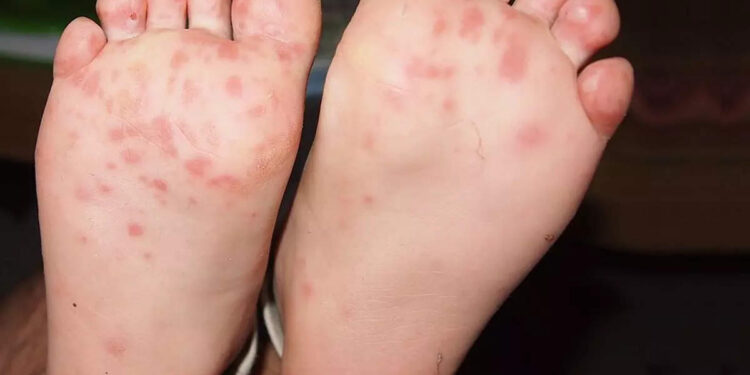 രാജ്യത്തെ-കുട്ടികളില്‍-പടരുന്ന-തക്കാളിപ്പനി-എന്താണ്?-രോഗലക്ഷണങ്ങളും-ചികിത്സയും