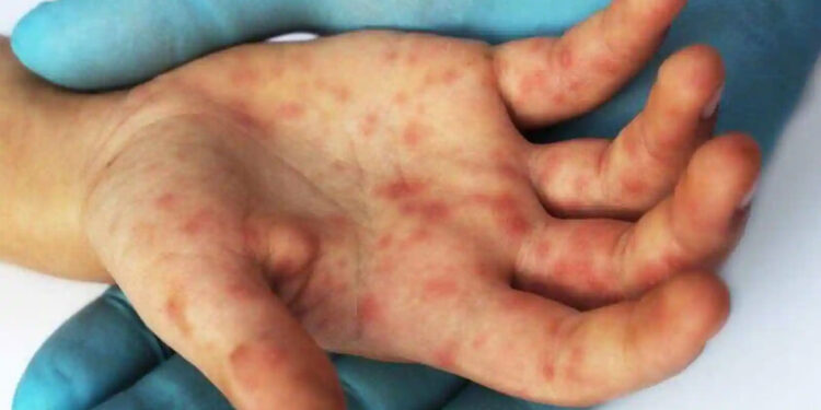 കേരളത്തിലെ-തക്കാളിപ്പനി-ഓസ്ട്രേലിയയിലേക്ക്-എത്താമെന്ന്-മുന്നറിയിപ്പ്