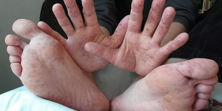 monkeypox-vs-tomato-flu-|-തക്കാളിപ്പനി,-മങ്കിപോക്‌സ്-ഇവയുടെ-ലക്ഷണങ്ങള്‍-വേര്‍തിരിച്ചറിയാം