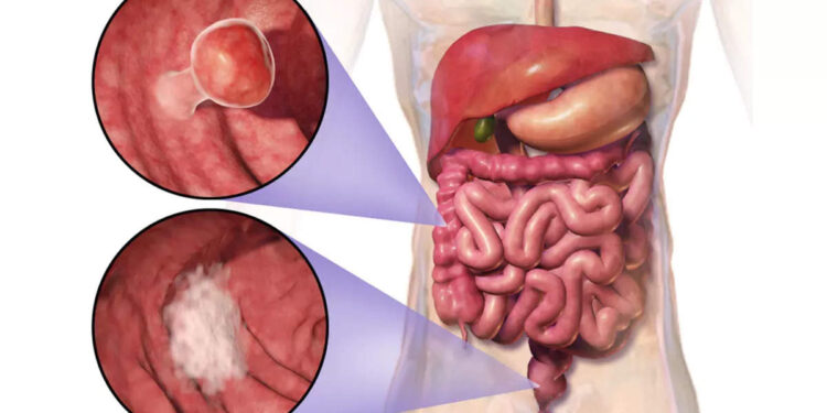 കുടലിലെ-അര്‍ബുദം-ശരീരത്തിന്റെ-മറ്റ്-ഭാഗങ്ങളിലേയ്ക്ക്-വ്യാപിക്കുന്നത്-തിരിച്ചറിയണം