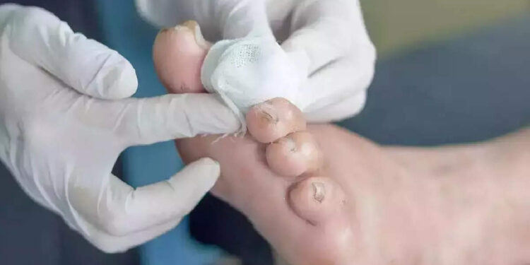 diabetes:-ഹൈപ്പര്‍-ടെന്‍ഷനും-പ്രമേഹവും:-കാലിലെ-മുറിവിന്-കാരണമാകുമോ?