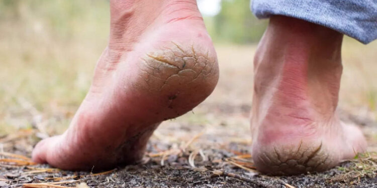 cracked-heels:-കാല്‍-വരവിള്ളുന്നതിന്-കാരണം-ഇതാണ്?-ഇത്-മാറാന്‍-ഈ-കാര്യങ്ങള്‍-ചെയ്യണം