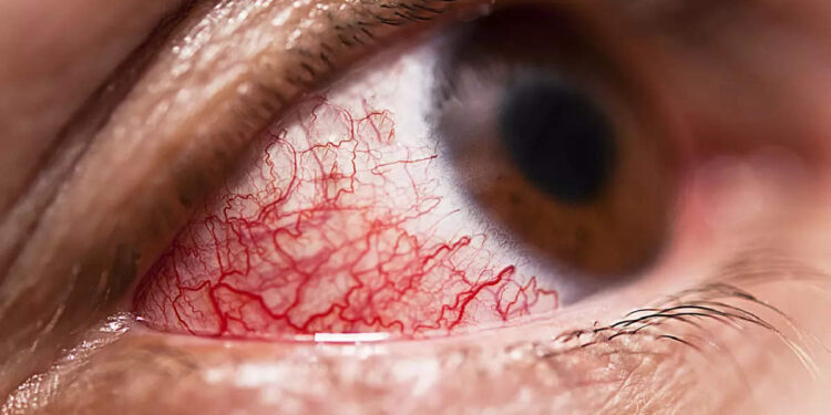 pink-eye:-ചെങ്കണ്ണ്-രോഗം-പടരുന്നു,-ഈ-കാര്യങ്ങൾ-ശ്രദ്ധിക്കാൻ-മറക്കരുത്