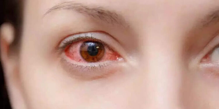 home-remedies-for-conjunctivitis:-ചെങ്കണ്ണ്-മാറ്റാൻ-പ്രകൃതിദത്തമായ-ചില-വഴികളിതാ