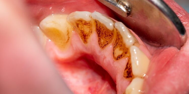 ​പല്ലിലെ-പ്ലാക്കും-ചായക്കറയും-കളയാന്‍ചില-വീട്ടുവൈദ്യം​