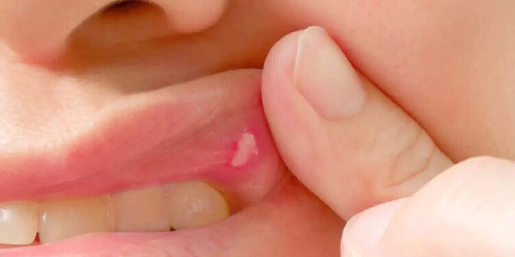 വായ്പ്പുണ്ണ്-കാരണം-പൊറുതിമുട്ടിയോ?-ഈ-വീട്ടു-വൈദ്യങ്ങൾ-പരീക്ഷിച്ചോളൂ