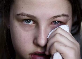 ചെങ്കണ്ണ്-മാറ്റാൻ-ആയുർവേദം-പറയുന്ന-ചില-പരിഹാര-മാർഗങ്ങൾ